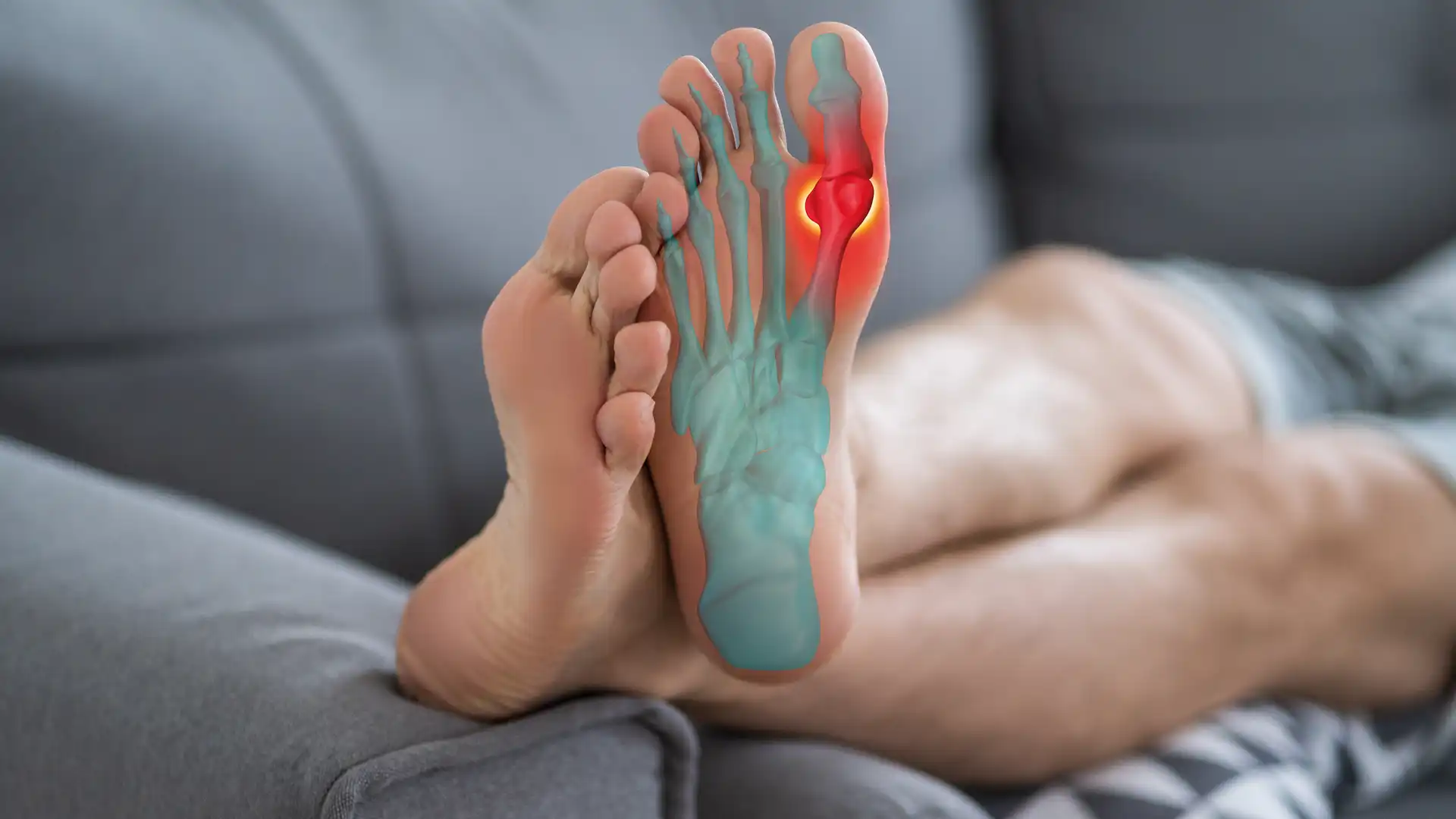 Wohlstandskrankheit Gicht