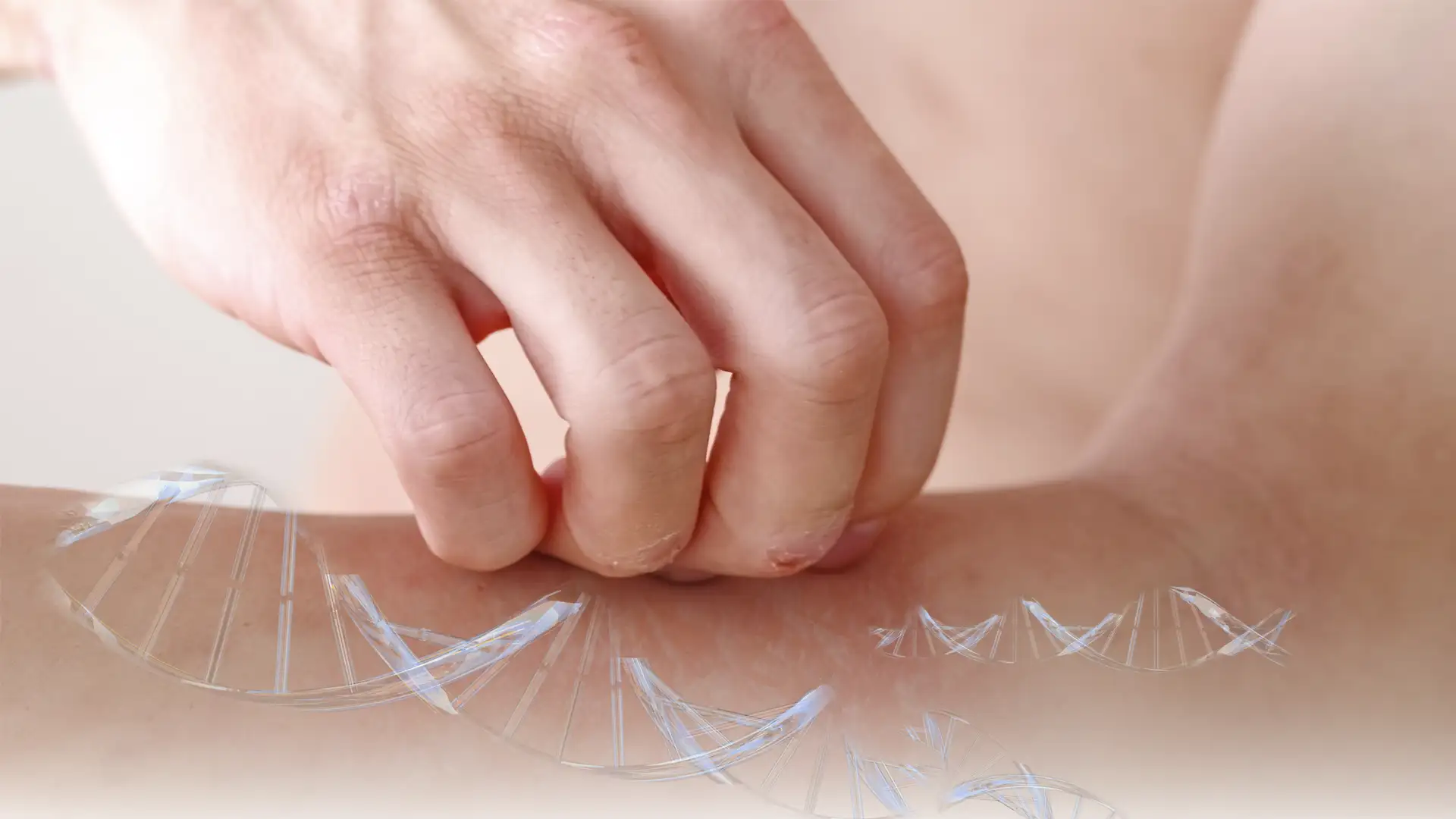 Neurodermitis - welche Rolle spielen die Gene?