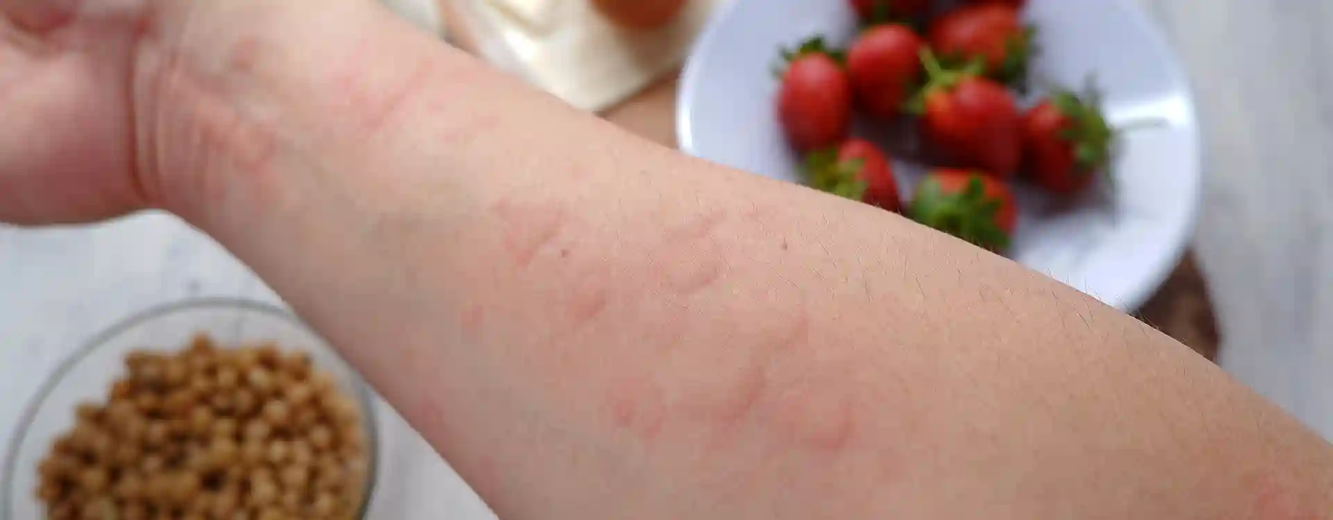 Wunderschne Allergie Auf Eiweiss Ebenbild