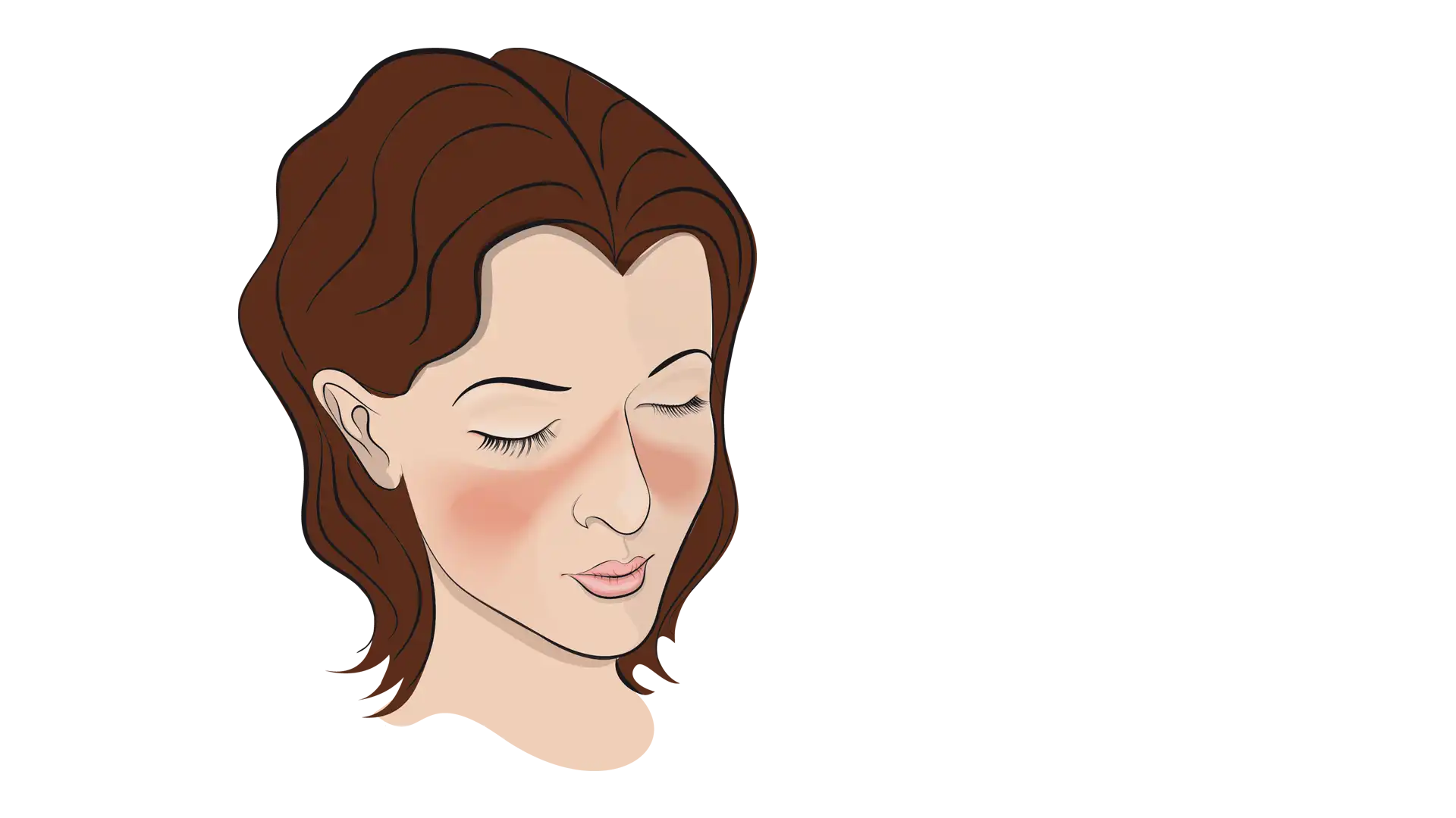 Systemischer Lupus Erythematodes