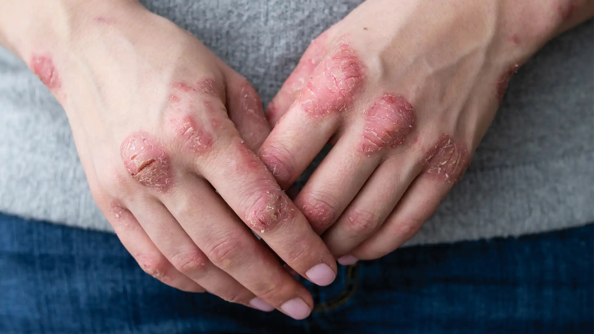 Psoriasis